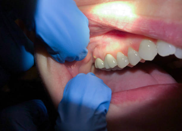 Best Lost Filling or Crown Replacement in Lakeshire, MO